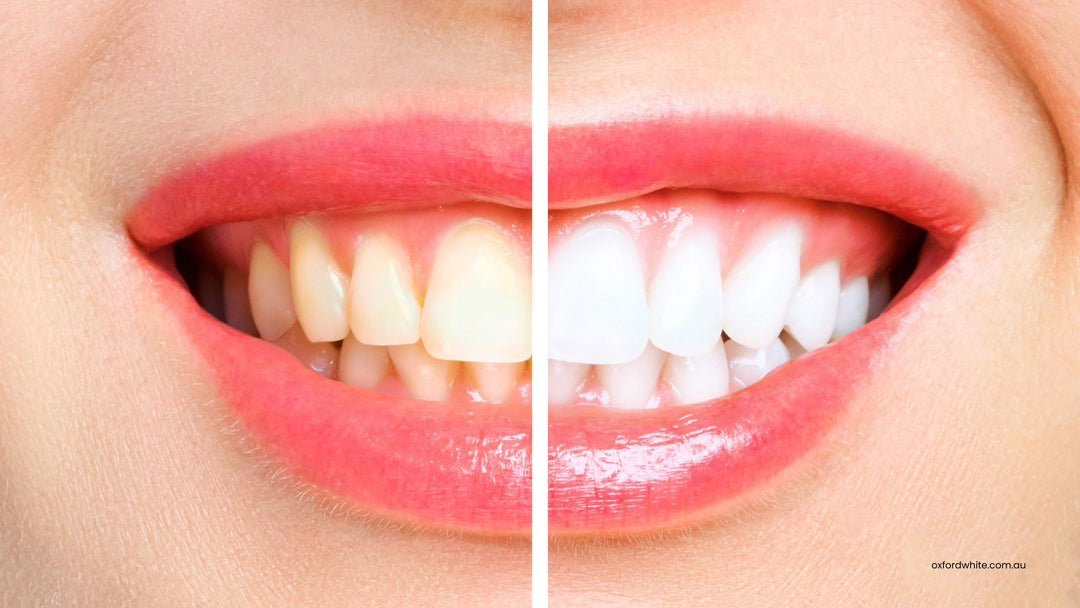 Which Vitamin Deficiency Can Result in Yellow Teeth?